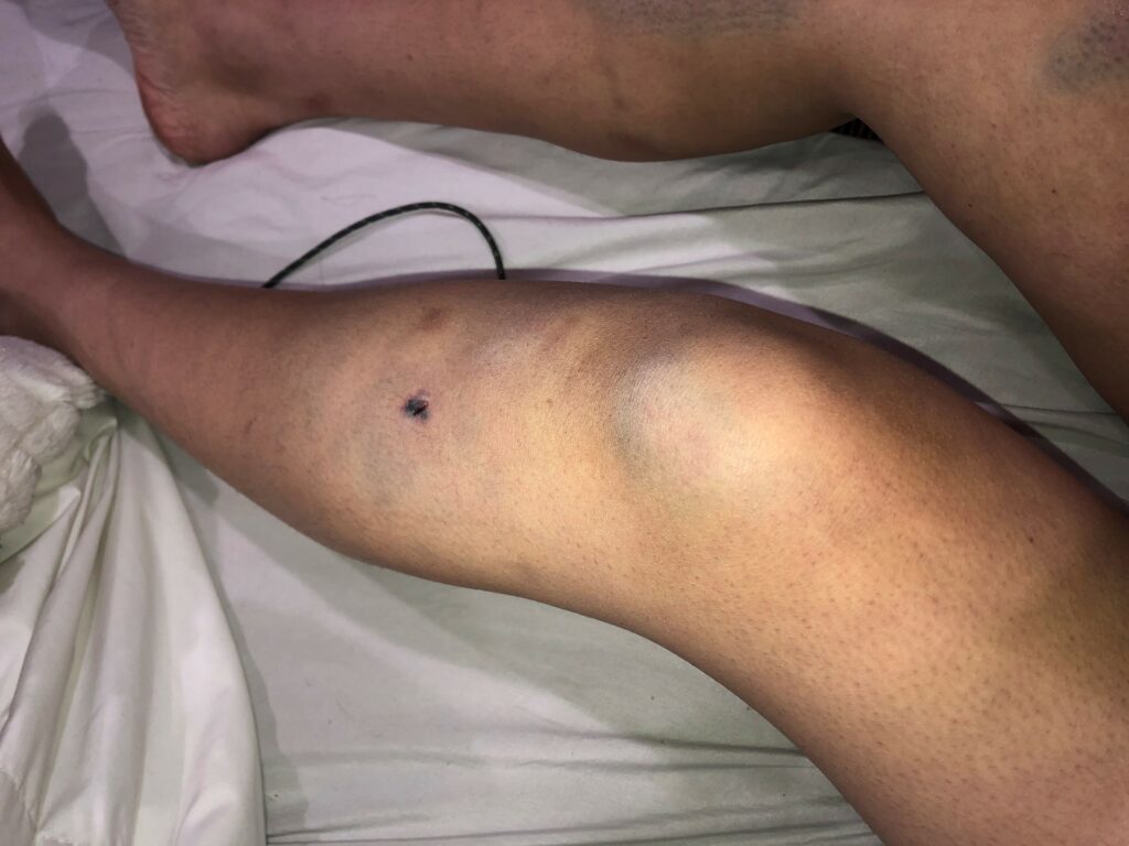 The car that ran a red light hit the victims from the side, resulting in bruises covering their bodies.
