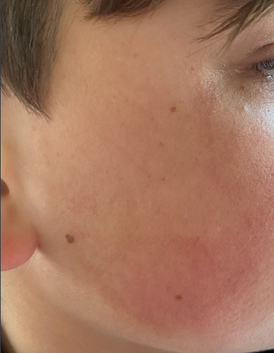 Marks and disfigurement on the face of the bicycle accident victim.
