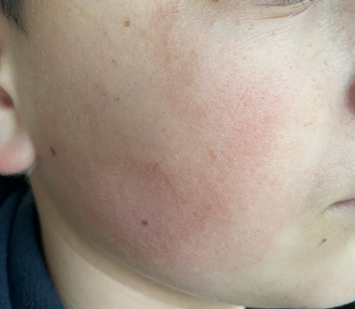 The victim's face scares due to injuries caused by being hit by a car while riding a bike.